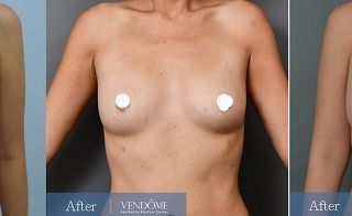 療程效果因人而異，上圖為A罩杯女性在做完自體脂肪隆乳之後手術後一年六個月、手術後一年十個月之成效